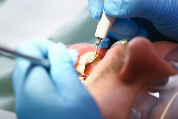 Best Emergency Dentist for Lost Fillings or Crowns in Lely Resort, FL
